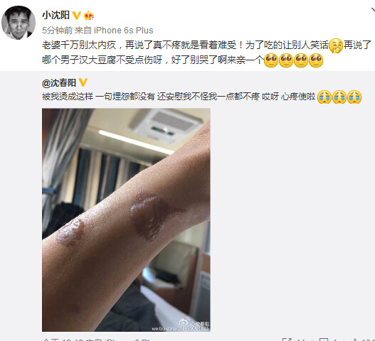 小沈陽(yáng)被愛(ài)妻燙傷手臂起包安慰妻子不要內(nèi)疚