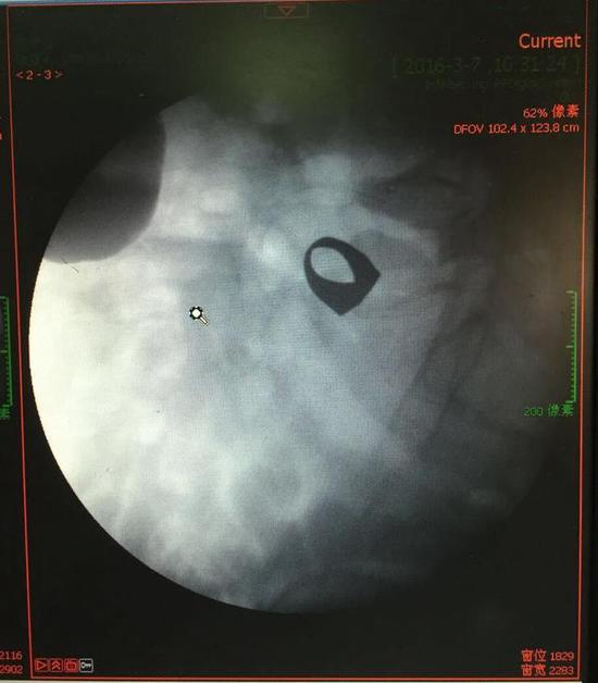 八旬老人信“民間仙方”吞13克金戒指