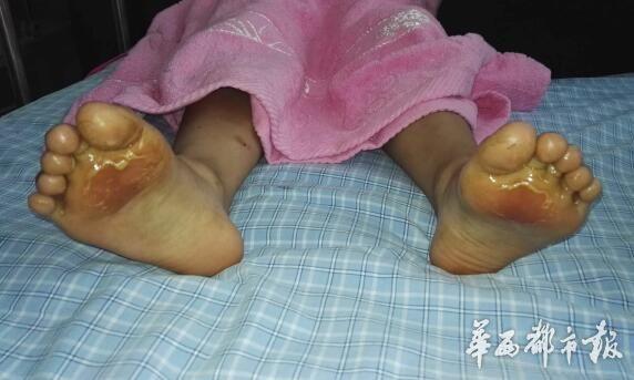 四川多名小學生37℃高溫下被罰光腳跑遭燙傷