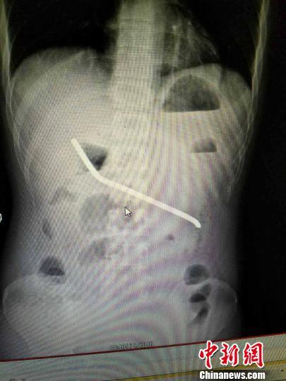 湖南一男子與女友拌嘴怒吞20厘米長鋼筋