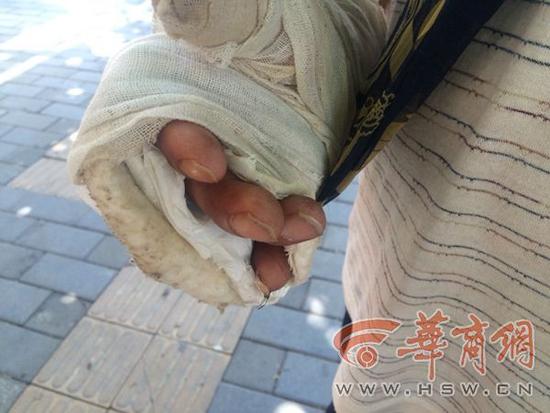 何師傅是5月初在丹鳳縣城迎賓大道干活時受傷的,當天他負責安裝路上的水泥管,吊車將管子吊起來時他在下面用手抓著管子往預設好的位置里放,不知為何吊車猛地抖了一下,管子隨之一歪,何師傅右手大拇指和小拇指同時被夾在兩根管子中間,當場斷了。