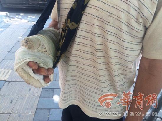 7月22日,華商報記者輾轉聯系上了工頭劉某,他說已經給何師傅墊付了近萬元的治療費用,現在他沒錢了,無能為力。丹鳳縣住建局負責此事的工作人員則說,何師傅是工頭招進去干活的,他們只負責調解,并表態將繼續敦促招工方妥善處理此事。